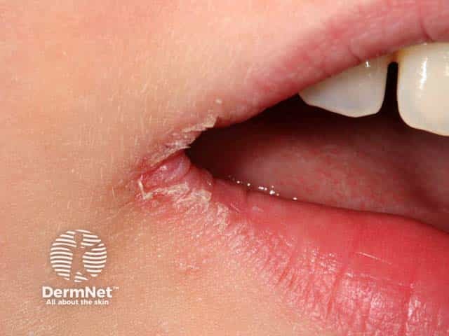 Angular cheilitis - close up