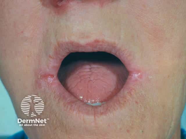 Angular cheilitis in a denture wearer