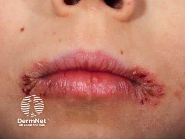 Eczematised and impetiginised angular cheilitis