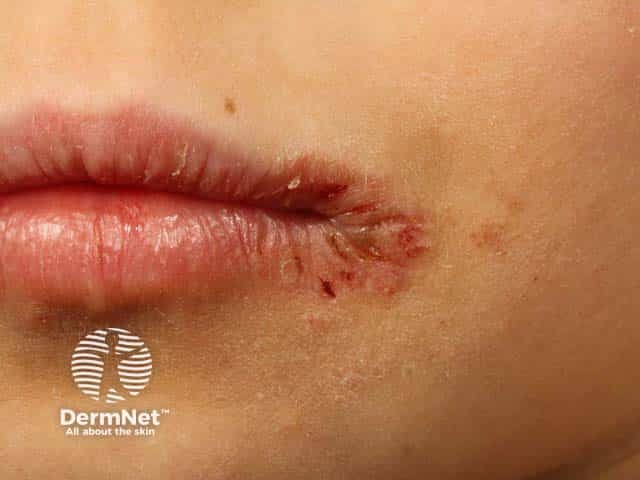 Eczematised and impetiginised angular cheilitis