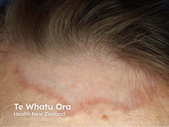 The well-demarcated edge of annular elastolytic granuloma on the forehead