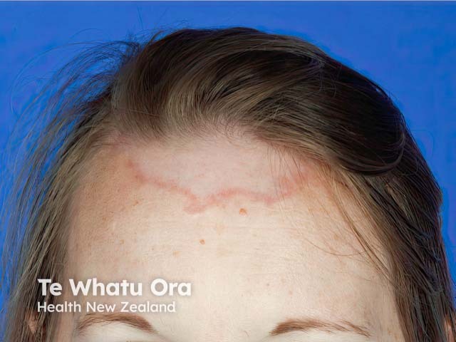 The well-demarcated edge of annular elastolytic granuloma on the forehead