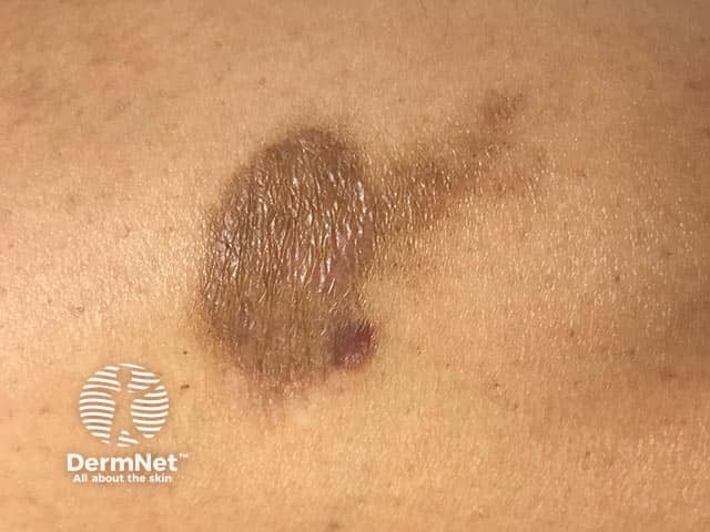 Resolving annular lichen planus leaving deep post-inflammatory hyperpigmentation