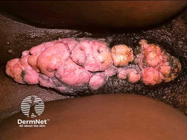Giant anogenital warts in HIV infection