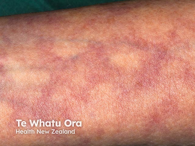 Livedo reticularis due to ANCA-associated vasculitis