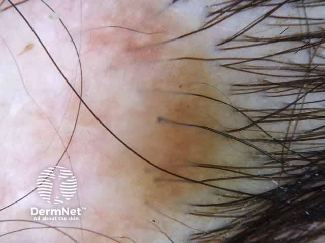 Dermoscopic image of aplasia cutis congenita showing visible hair bulbs on the scalp of a female child.