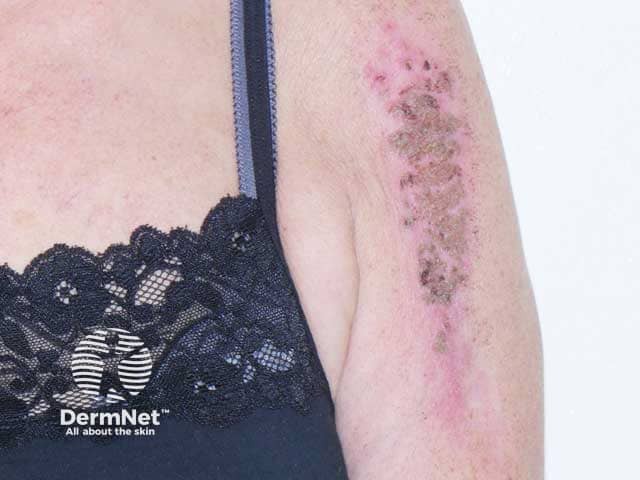 Excoriations on the upper arm due to severe aquagenic pruritus with polycythemia