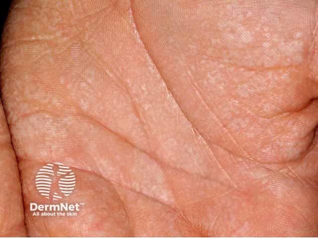 Close-up of aquagenic wrinkling of the palm after 5 minutes of immersion - masses of small papules and oedema are evident