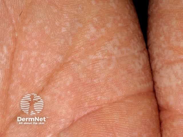 Close-up of aquagenic wrinkling of the palm after 5 minutes of immersion - masses of small papules and oedema are evident