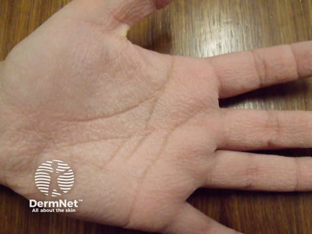 Marked wrinkling of the palmar skin after 5 minutes of immersion - it was accompanied by pain and itch