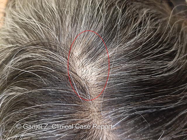 Short hairs can be seen in this sudden onset alopecia due to  the actions of a barber ant