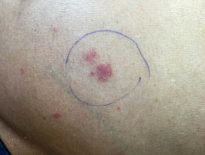 Atopic dermatitis in adult with skin of colour