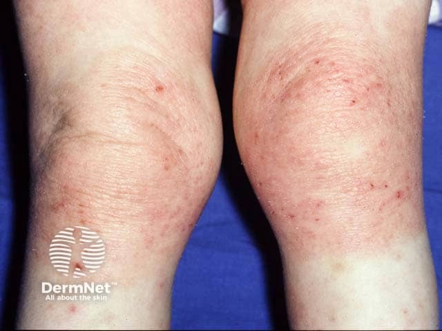 Lichenified atopic eczema on the knees (so called reverse pattern eczema)