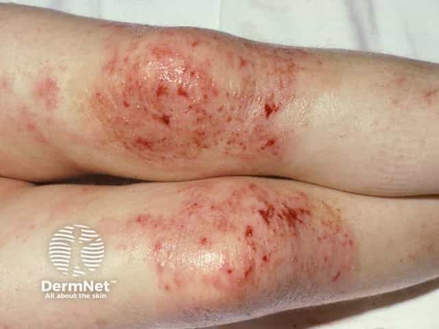 Excoriated acute eczema on the extensor aspects of the knees (reverse pattern)