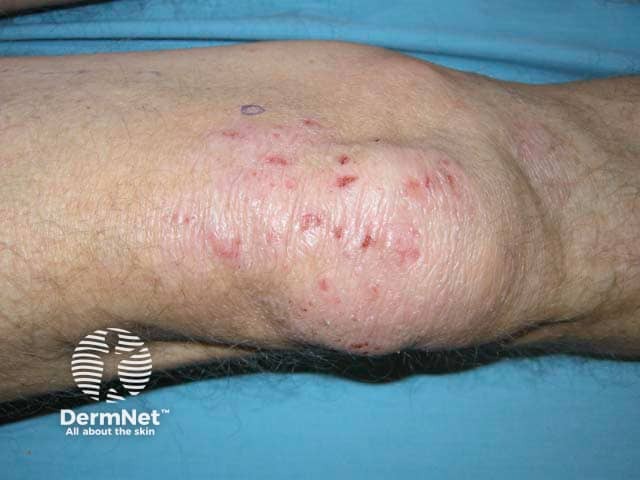 Atopic eczema on the knee - excoriations and lichenification are clear