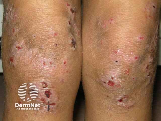 Lichenified and excoriated atopic eczema on the knees