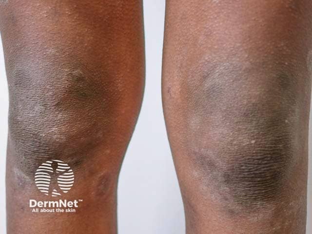 Lichenification and hyperpigmentation on the knees in skin of colour due to atopic eczema