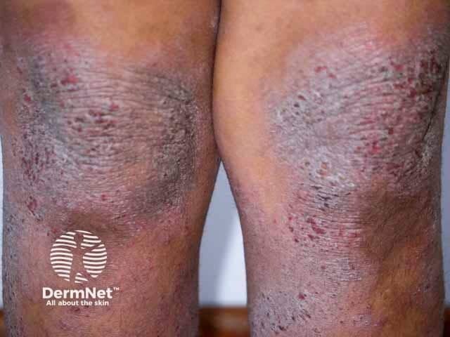 Lichenification and hyperpigmentation on the knees in skin of colour due to atopic eczema