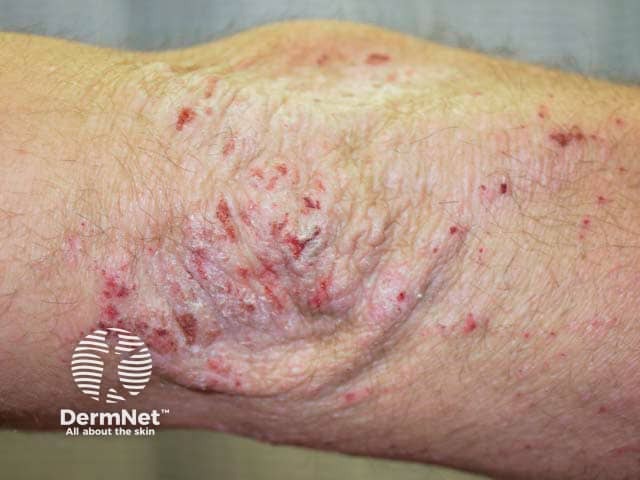 Lichenified and excoriated chronic eczema on the elbow