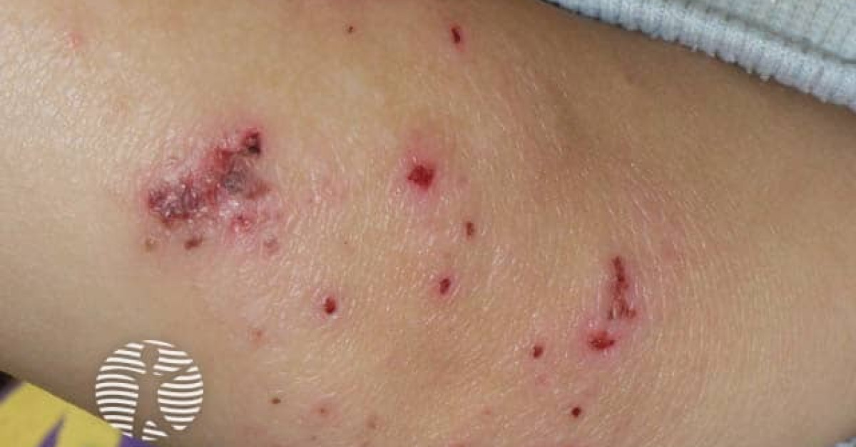 Atopic dermatitis image