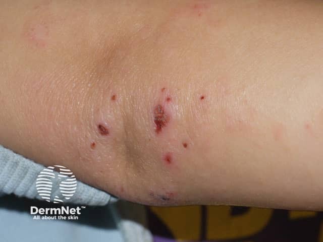 Excoriated eczema on the elbow