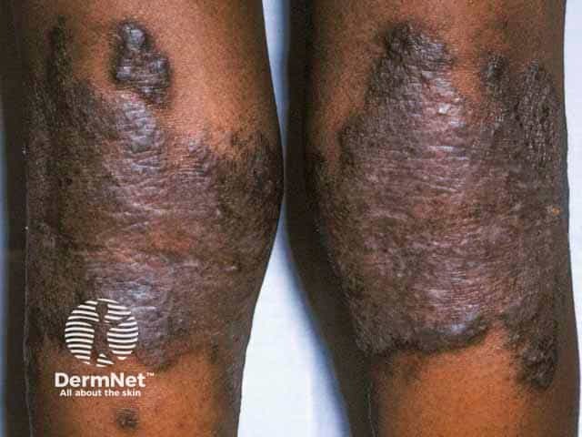 Heavily lichenified hyperpigmented eczema behind the knees of an African boy