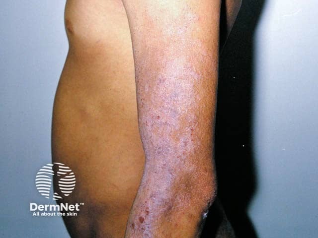 Chronic changes of atopic eczema with inflammation, scale and lichenification on the arm in skin of colour