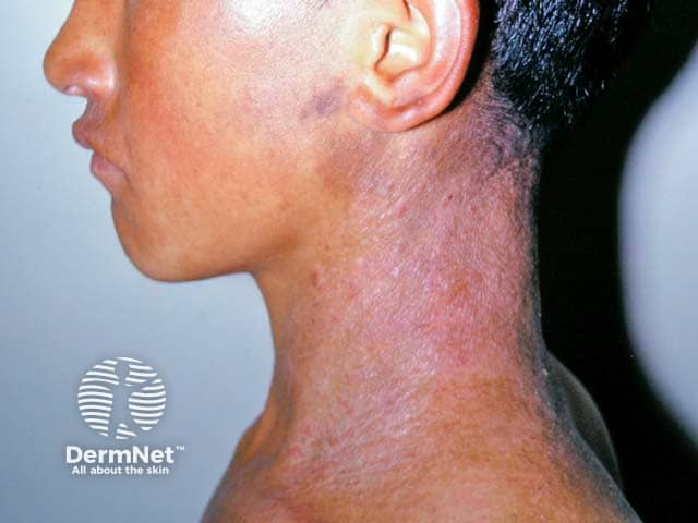 Lichenified atopic eczema on the neck in skin of colour