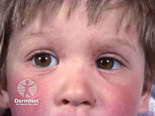 Facial and lid eczema in a toddler.  Dennie-Morgan folds are evident on the lower lids