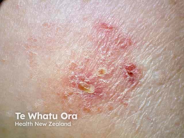 Scale, crusts and hyeprkeratosis in ankle atopic eczema in an adult