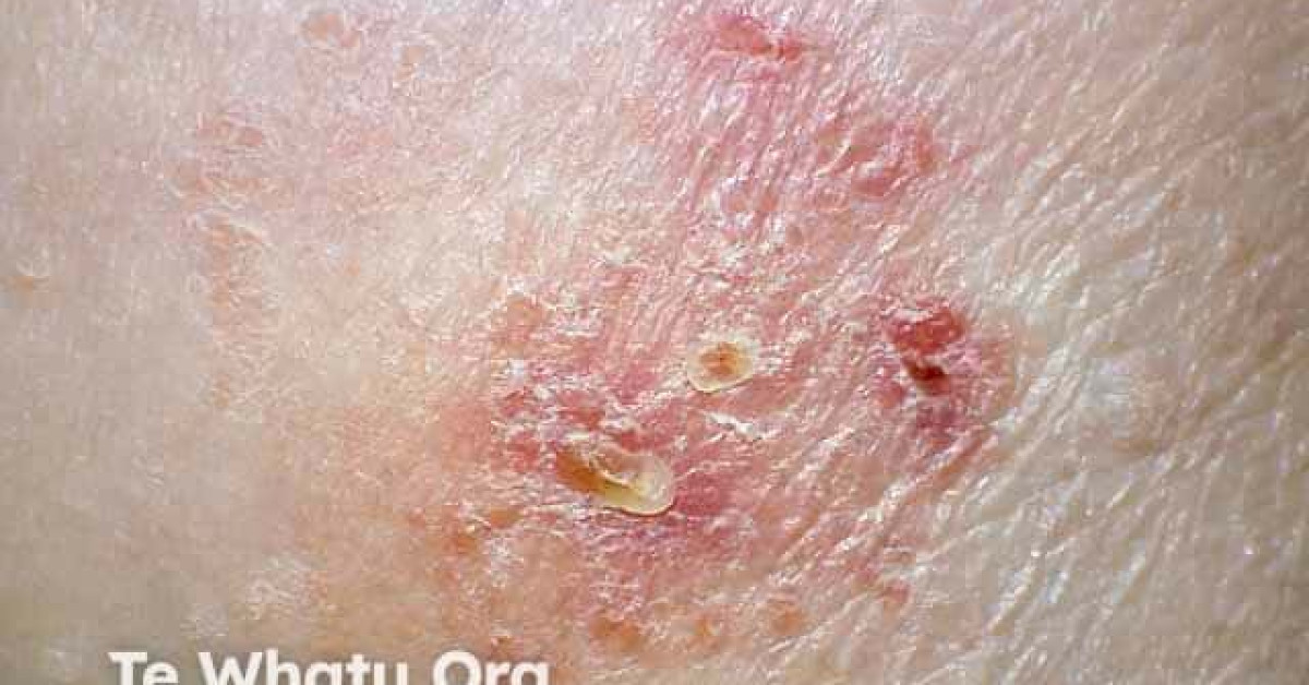 Atopic Dermatitis Image