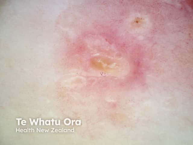 Dermoscopy of atopic eczema - clusters of dotted vessels and yellow scales