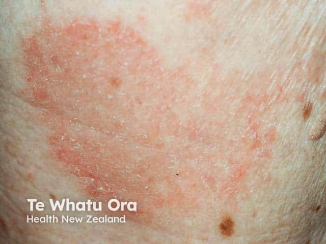 Atopic eczema on the thigh showing redness and a well-defined scaly edge with some crusting