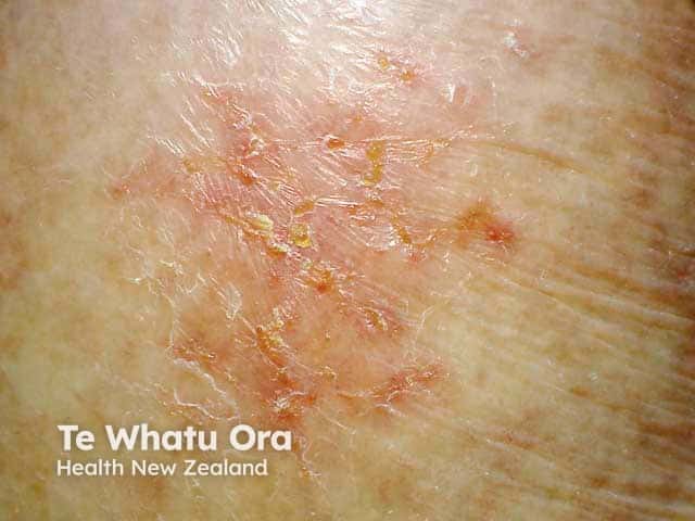Crusted exudative atopic eczema in an adult