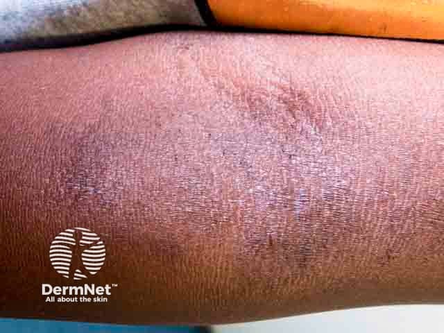 Accentuation of the skin creases - the hallmark of lichenification in atopic eczema in the antecubital fossa
