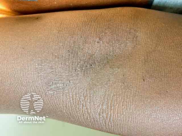 Accentuation of the skin creases - the hallmark of lichenification in atopic eczema in the antecubital fossa