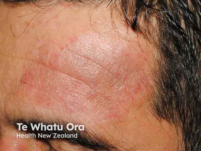 Lichenified and exudative atopic eczema on the face