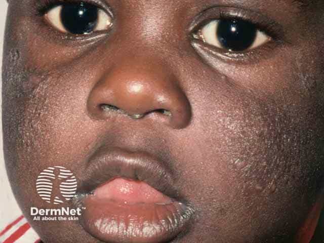Lichenified and scaly cheek atopic eczema in an African toddler
