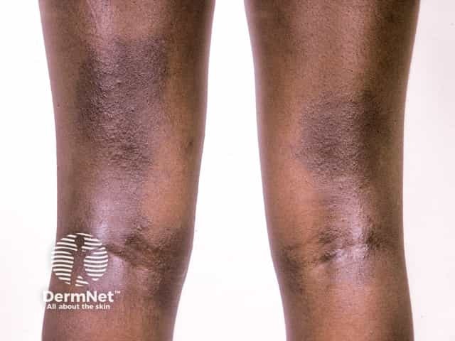 Lichenification and hyperpigmentation in atopic eczema on the back of the knees and thighs