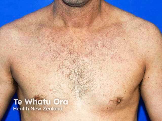 Atopic eczema over the neck and upper trunk