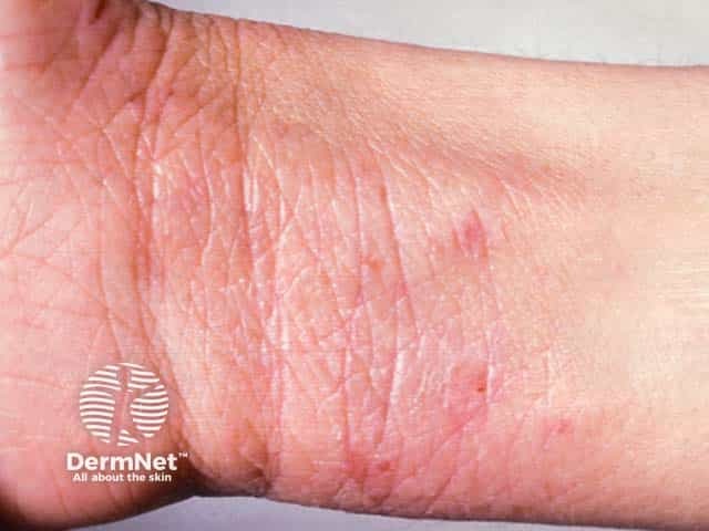 Lichenified atopic eczema on the volar wrists