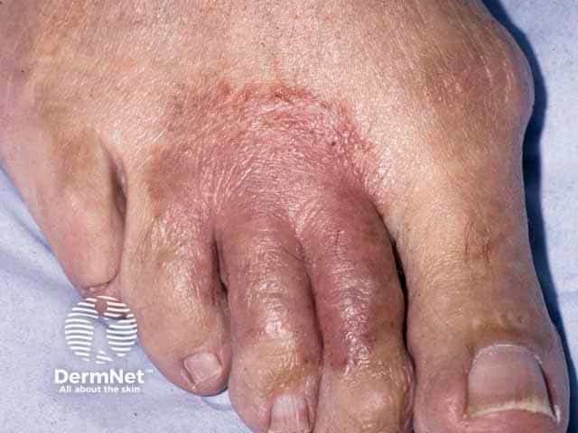 Atopic eczema on the dorsal foot - fungal infection needs to be excluded