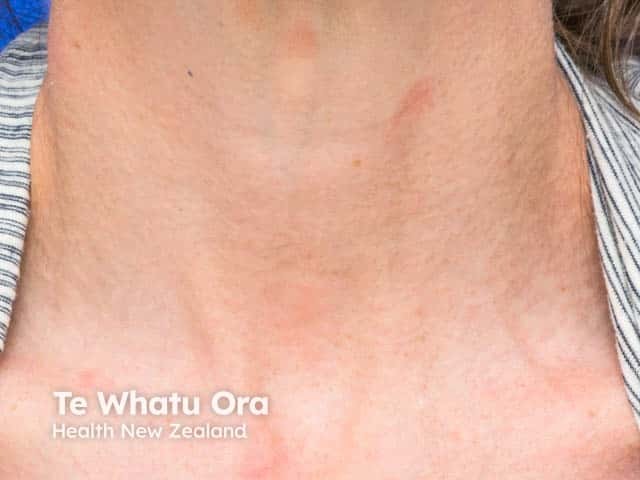 Atopic neck eczema