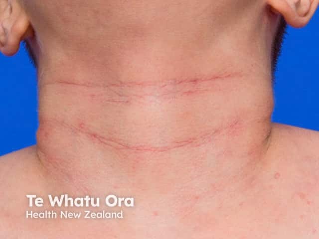 Atopic eczema - redness is accentuated in the neck skin folds