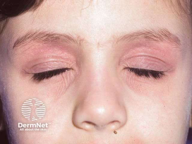 Bilateral redness and lichenification of the lids due to atopic eczema