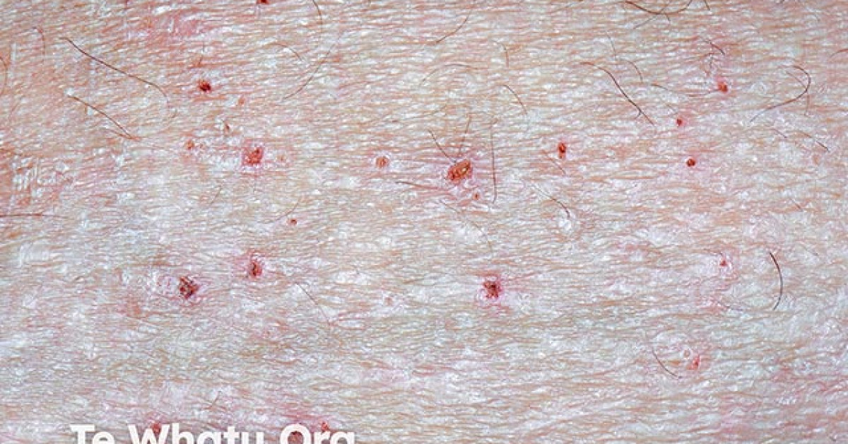 Atopic dermatitis image