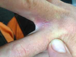 Atopic hand dermatitis