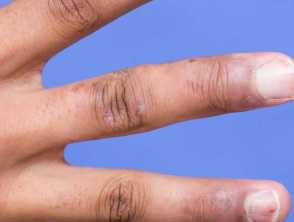 Atopic hand dermatitis