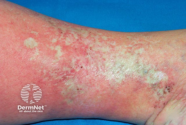 Venous eczema