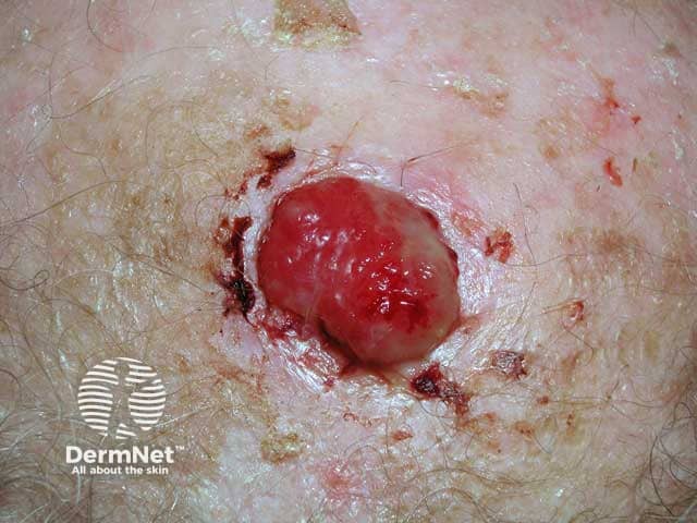 An ulcerated atypical fibroxanthoma on a bald scalp